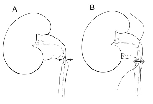 Diagram of surgical procedure on the kidney