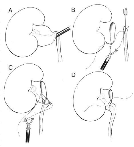 Diagram of surgery on the kidney
