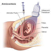 An illustration of how an amniocentesis is performed.