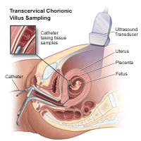An illustration showing how a chorionic villus sampling is performed.