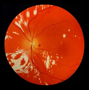 retinal changes from diabetes