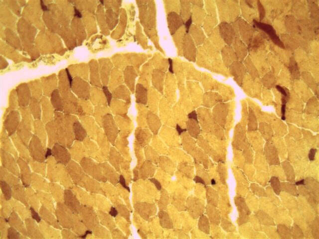 acute neurogenic atrophy as seen under a microscope