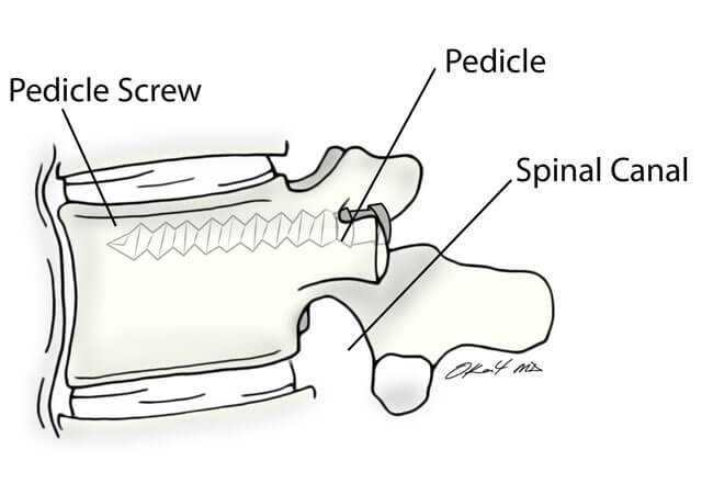 Illustration of a spinal cord and pedicle