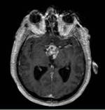 pre-op axial craniopharyngioma (pituitary tumor)
