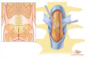 En una rizotomía dorsal selectiva para el tratamiento de la espasticidad, algunas de las raíces de los nervios raquídeos de los segmentos lumbosacros son recortados para aliviar el exceso de tono muscular