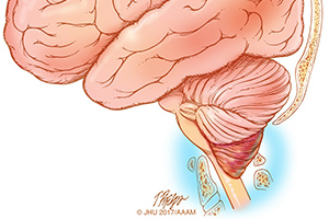 En la malformación de Chiari, la parte inferior del cerebro (el cerebelo) se extiende por debajo hacia el conducto raquídeo