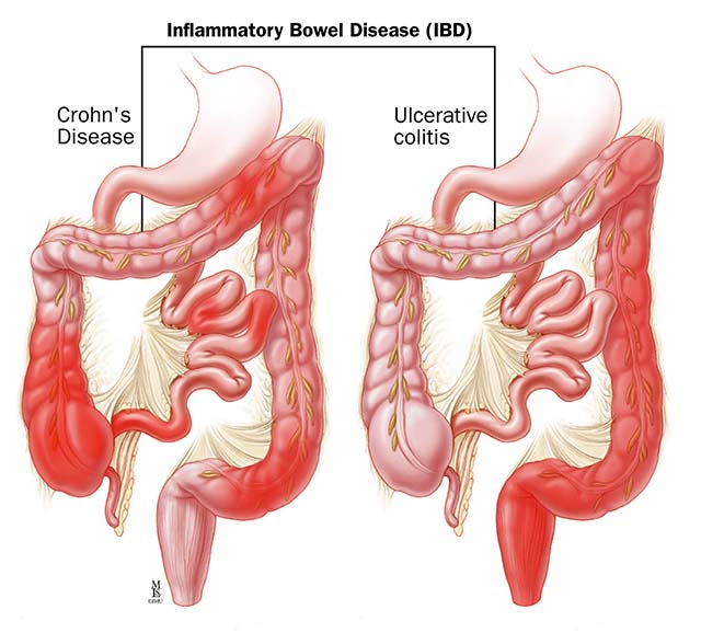 crohns and ulcerative colitis diagram
