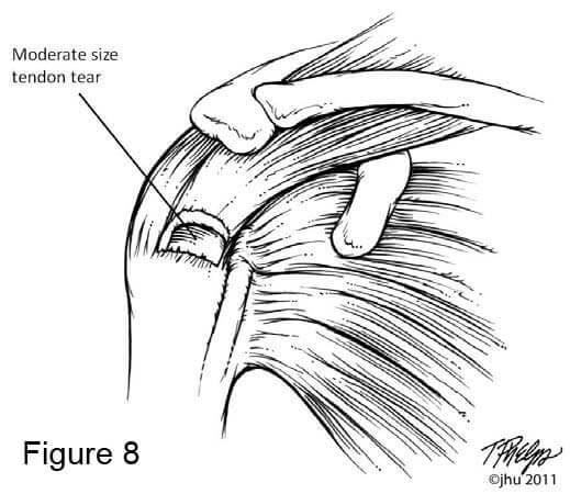 Shoulder diagram showing moderate sized rotator cuff tear