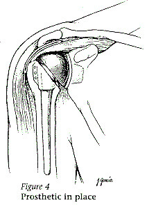 Illustration of a shoulder joint prosthetic in place. Described under the heading What part of the shoulder is replaced?