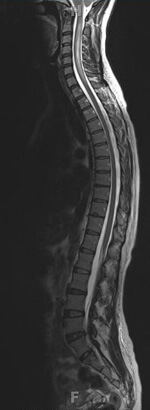 MRI of a human spine