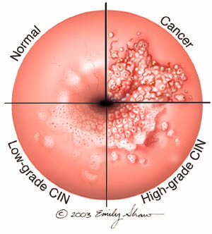 is hpv cancer cells)