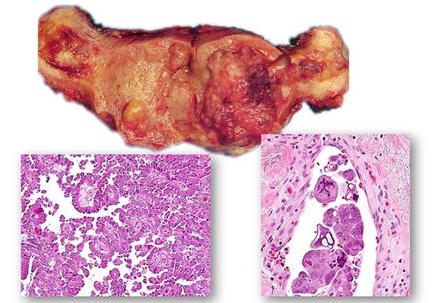 The molecular landscape of uterine serous carcinoma is explored.