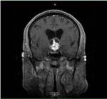 pre-op coronal craniopharyngioma (pituitary tumor)