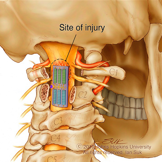 A medical illustration shows the back of the skull with an electrical implant placed where the neck and spine meet.