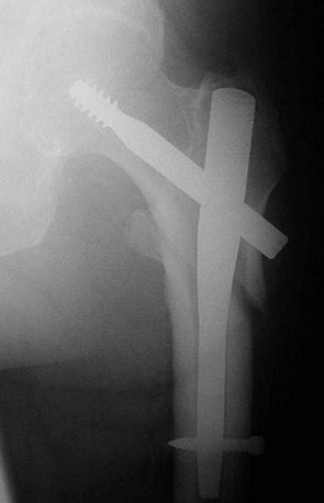 short intramedullalry hip screw