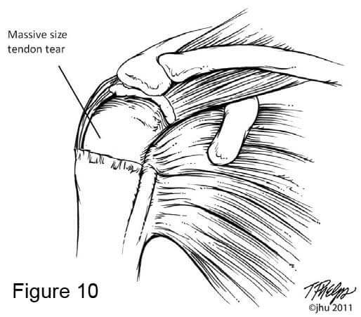 Shoulder diagram showing massive rotator cuff tear