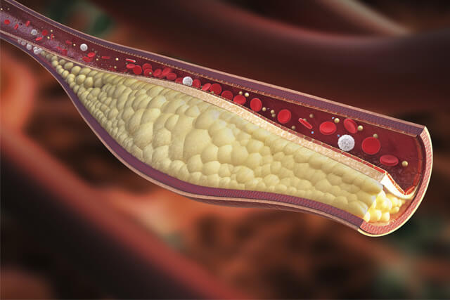 Anatomical illustration of lipids in vein