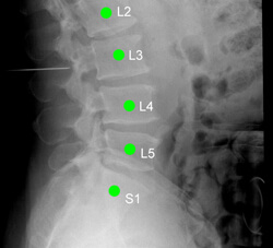 an X-ray image of a patient's spine with each vertebra labeled