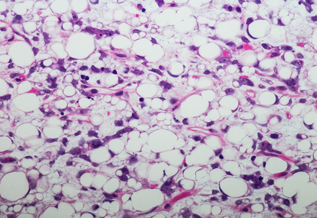 liposarcoma cells