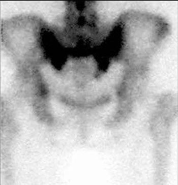 Radionuclide bone scans 