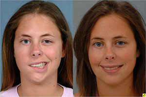A la izquierda: Paciente antes del tratamiento de parálisis facial. A la derecha: Paciente después de recibir el tratamiento.