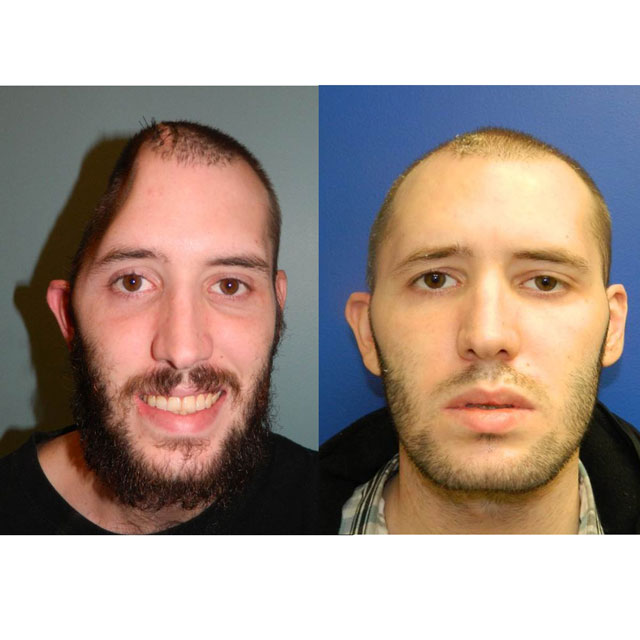 Before and after photos of a patient who underwent surgery using the pericranial-onlay cranioplasty technique. 