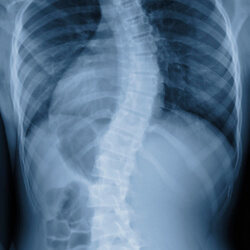a xray showing the S-shaped spine of a patient with scoliosis