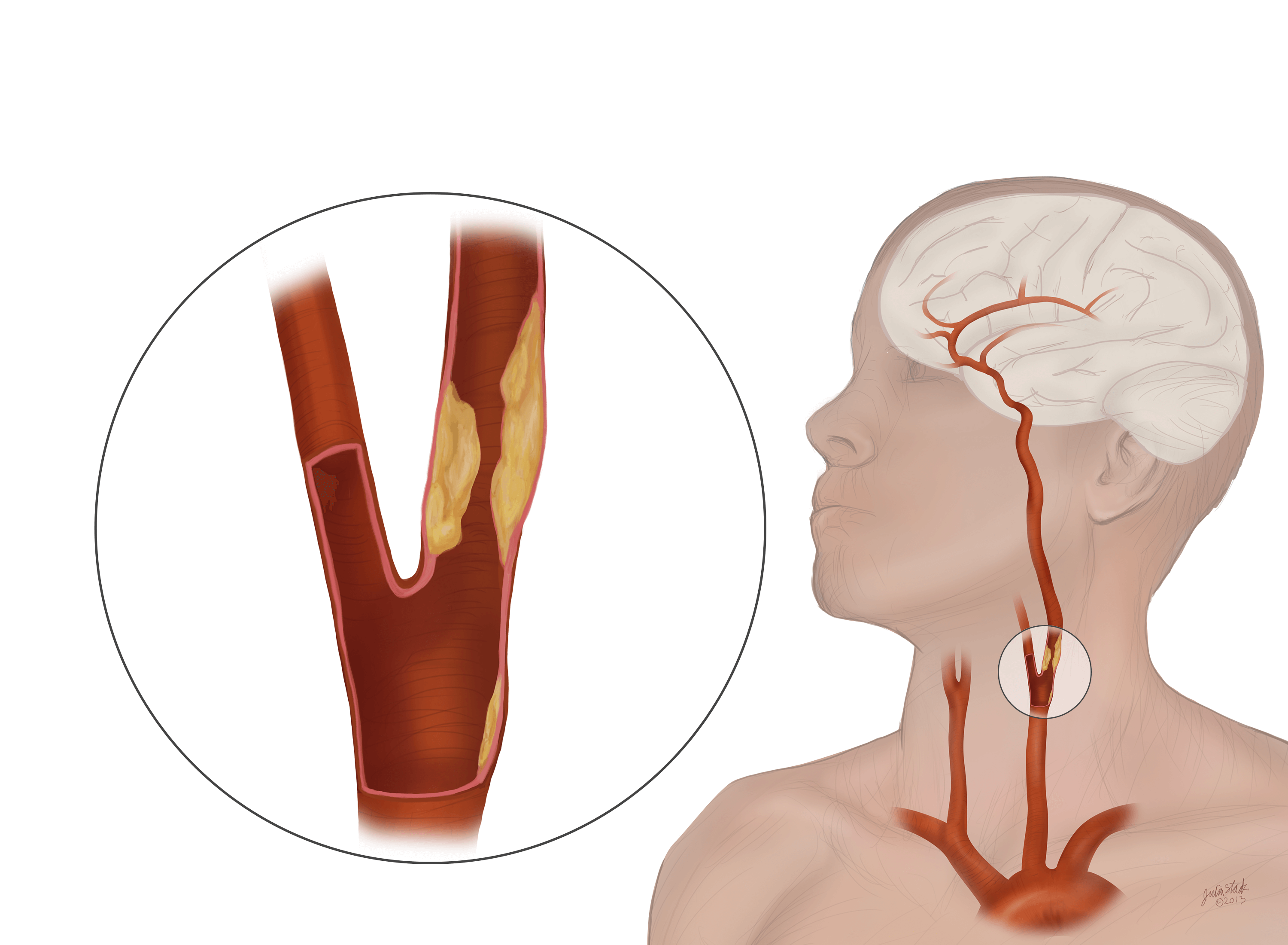 Boala arterei carotide