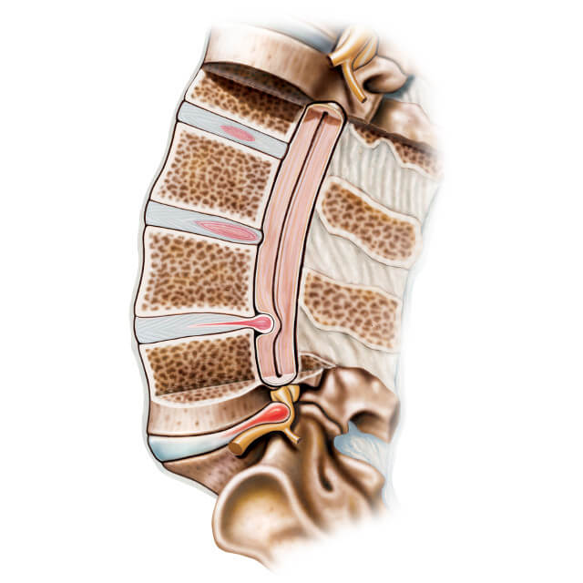 An illustration of a herniated disc in the spine