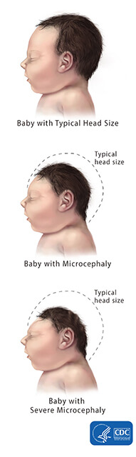 3 diagrams of infants with small heads