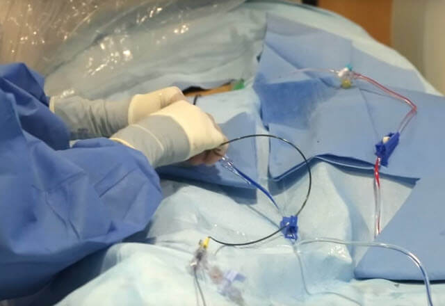 surgery for arteriovenous malformation