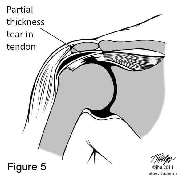Shoulder diagram showing a partial rotator cuff tear