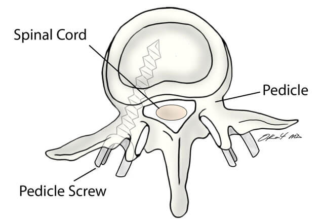 Illustration of a spinal cord and pedicle
