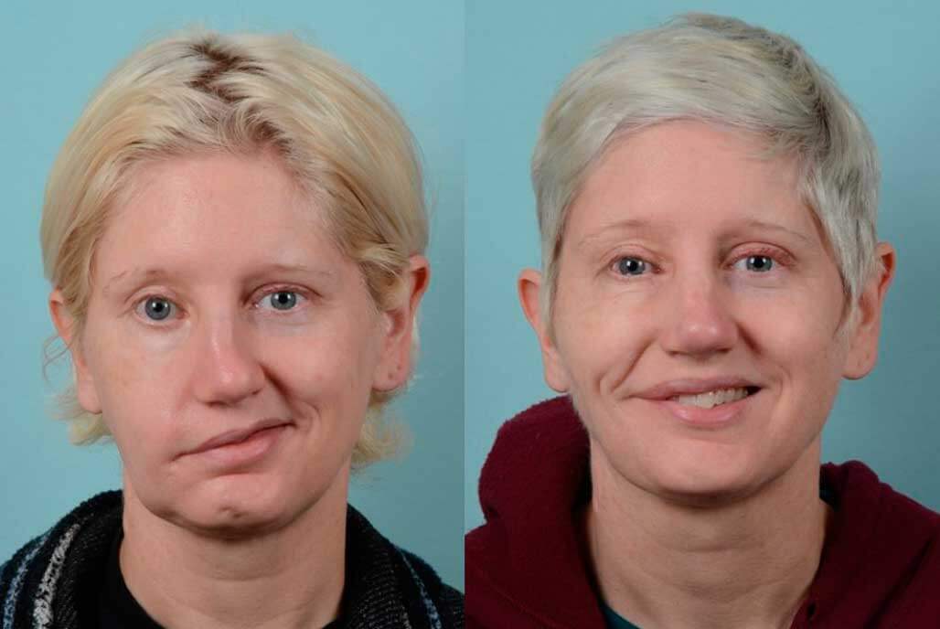 How to fix asymmetrical face without surgery. 