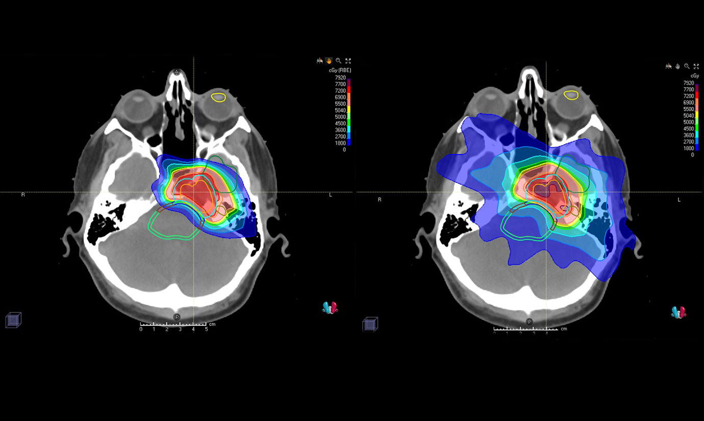 Two black-and-white brain scans have colored areas representing radiation dosage, showing proton therapy with a smaller affected area and traditional photon radiation with a larger affected area.