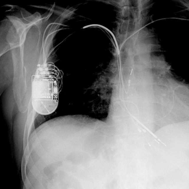 An xray shows a young patient with multiple wires. 