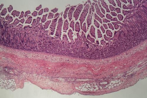 An image shows inflammation of the large intestine.