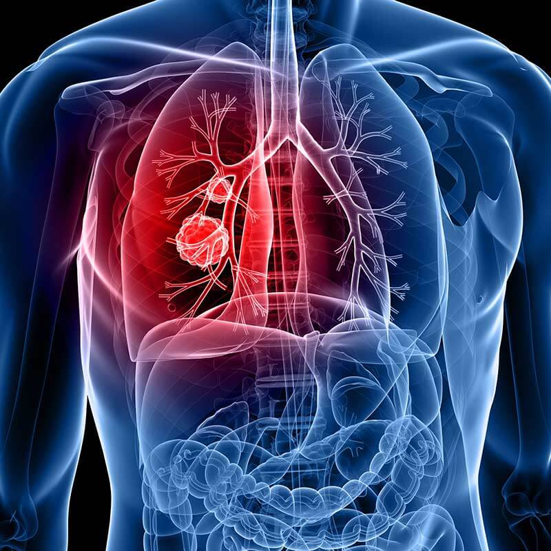 Lung Cancer Diagram For Kids