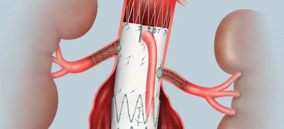 illustration of a Fenestrated endovascular aortic stent graft