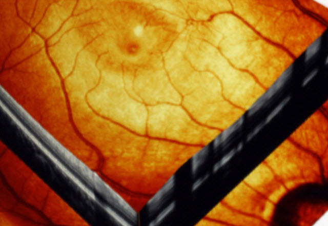 Research Update – Studies of Retinal Function Imager in MS