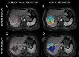 3D scans for liver tumors