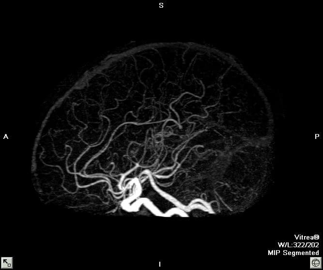CT images of whole brain and blood vessels