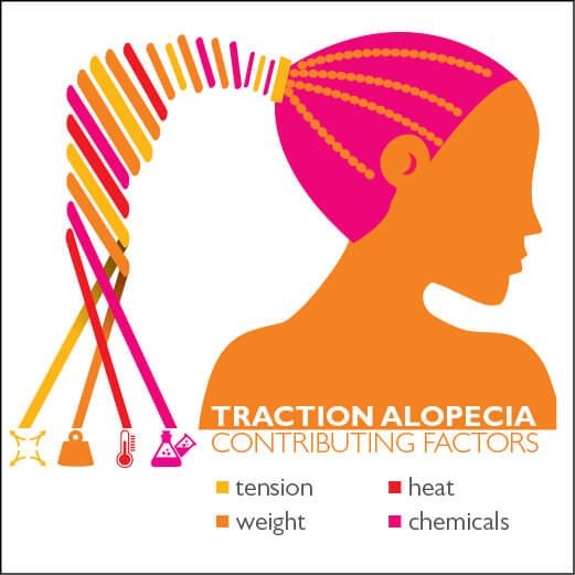 Traction alopecia image