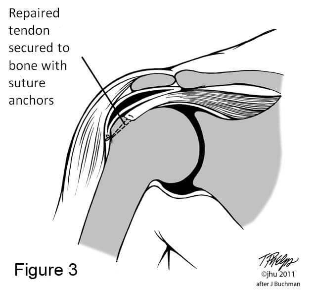 Shoulder diagram showing a repaired rotator cuff tendon secured to bone