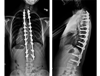 x-rays of maggie's spine after surgery