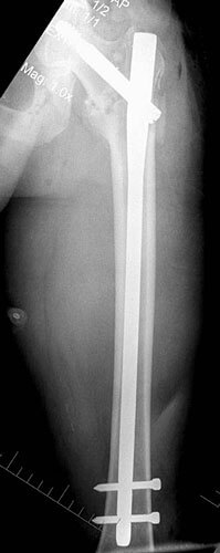 long intramedullary hip screw
