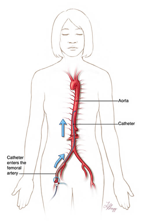 Illustration showing the catheter entering the femoral artery and it's path up the aorta to the spinal arteries.