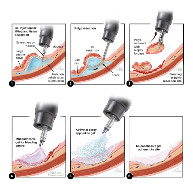 Illustrations depict step-by-step process for applying the new gel. 