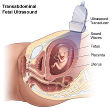transabdominal fetal ultrasound