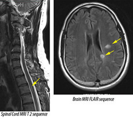Multiple Sclerosis MRI panel